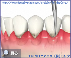 歯周病の初期治療